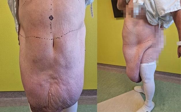 무릎 아래까지 처진 '35㎏ 복부 종양'…50대 남성 성기 파묻혔다